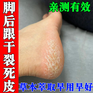 脚后跟干裂真菌感染脱皮鳞屑角化型脚气脚底增厚干裂粗糙修护霜