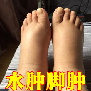 消肿去水肿专用老人脚肿消肿的药利尿排小腿水肿下肢浮肿特效神器