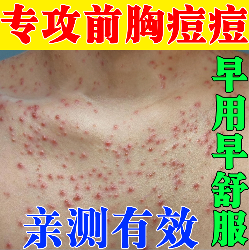 胸前痘痘胸口发红发痒长小红点疙瘩背上脓包前胸后背祛痘专用药膏