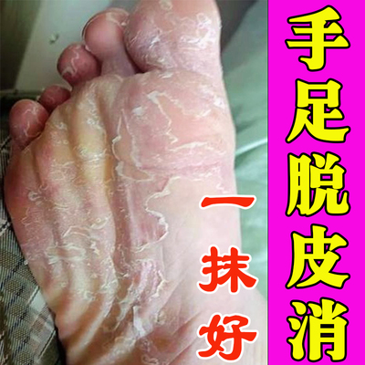 手足脱皮药膏严重脱皮专用真菌蜕皮治手干燥裂手指起皮儿童换季痒