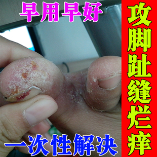 脚趾缝糜烂痒烂脚丫专用脱皮痒外用膏脚指间分离发白溃烂起小水泡