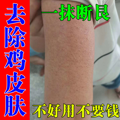 去除鸡皮肤疙瘩毛囊角化药膏胳膊鸡皮肤去除神器胳膊毛孔粗大堵塞