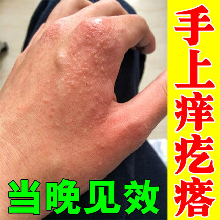 湿疹止痒去外用根顽固皮炎手背上长小疙瘩痒无激素汗疱疹外用药膏