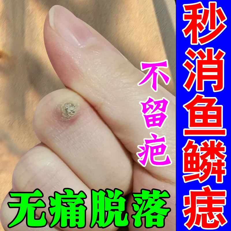 肉刺猴正品去手指肉粒疙瘩去除手上鱼鳞痣药祛神器脚手足部肉刺膏
