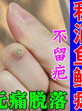 肉刺猴正品去手指肉粒疙瘩去除手上鱼鳞痣药祛神器脚手足部肉刺膏