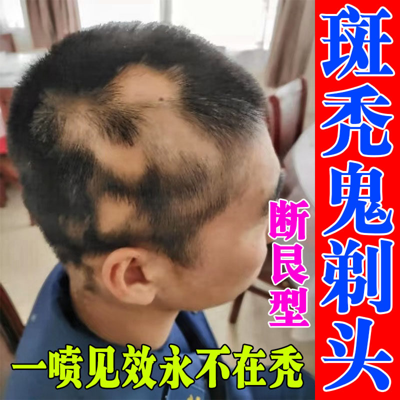 儿童斑秃液头顶掉头发鬼剃头严重脱发地中海增发密发专用喷剂