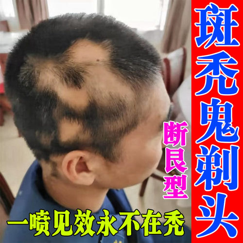 儿童斑秃液头顶掉头发鬼剃头严重脱发地中海增发密发专用喷剂