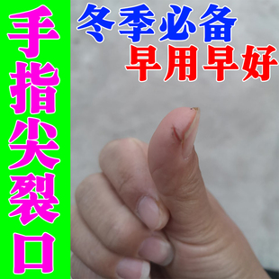 手指头裂口子干裂修复霜秋冬季指甲缝开裂脱皮疼痛防皲裂愈合药膏