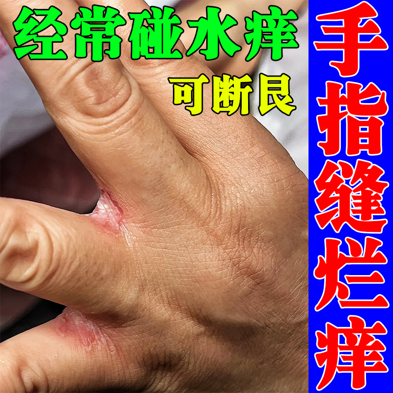 烂手丫糜烂瘙痒干裂疼痛手指缝溃烂经常碰水真菌感染手癣专用药膏