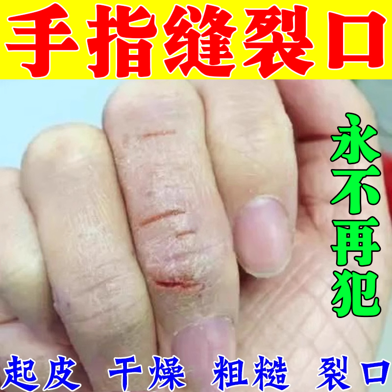 手裂口干裂修复霜秋冬季指甲缝干裂手指脱皮开裂手足干裂防皲裂膏