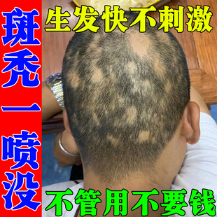 斑秃特效鬼剃头药防脱发专用克星洗发水一抹灵生姜液神器遮盖