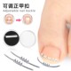 新款 正甲扣脚趾固定贴甲沟卷甲嵌甲物理可调拉伸拆卸男女可用