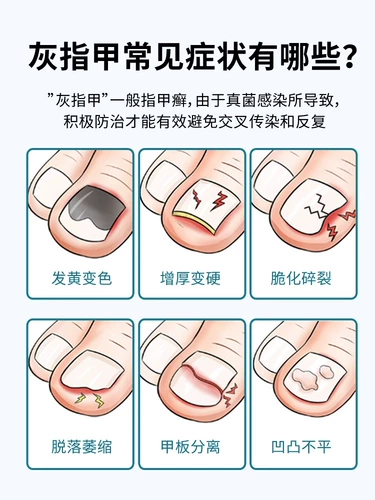 Официальный флагманский магазин OnchomyCosis для лечения специальных лекарств для лечения выделенных лекарств на ашалион или особого эффекта лечения корня специальной медицины подлинная грибковая инфекция