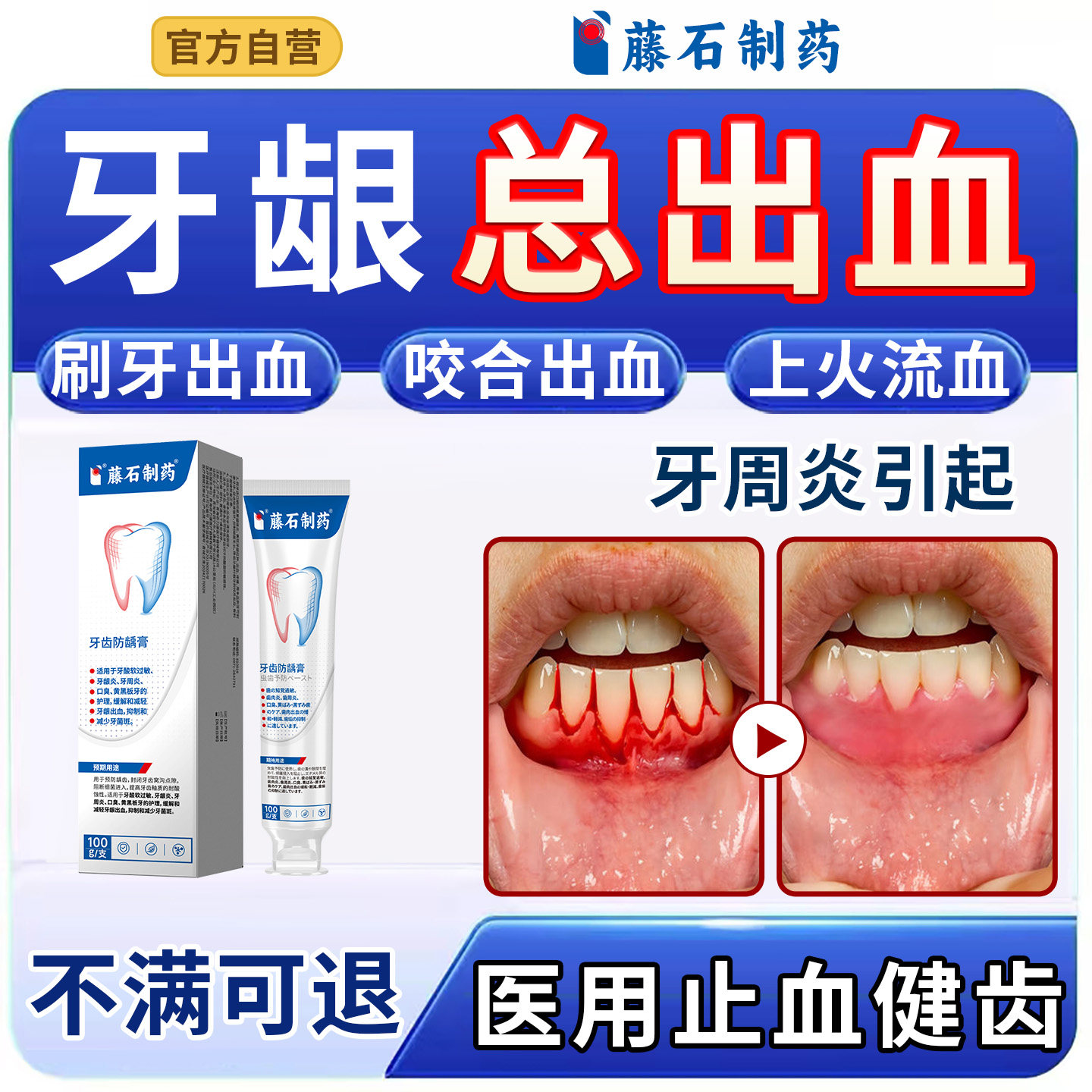 牙龈出血牙周炎专用可搭牙膏仙鹤草止血护龈健齿抗敏美白去黄去xu