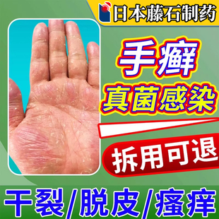 手癣膏脱皮干裂真菌感染手足癣湿疹去止痒根藓鹅掌风手气手指OA
