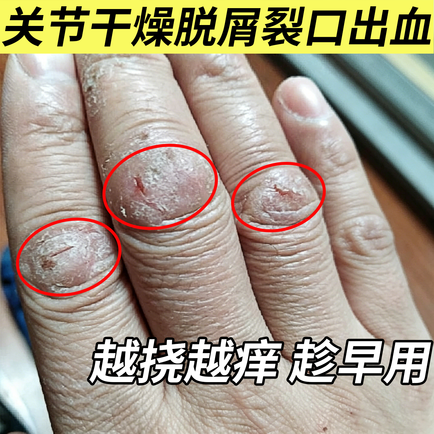 手指关节癣修复喷剂手癣皮肤干燥脱屑瘙痒增厚裂口鹅掌风手足癣OM