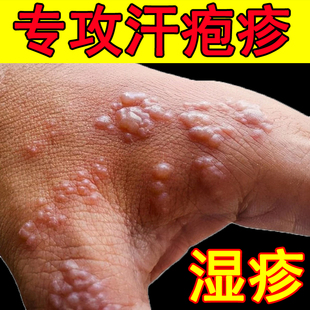 日本汗疱疹湿疹止痒抑菌喷雾剂去手脚脱皮阴囊内侧股藓汗泡根药膏