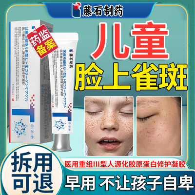 儿童脸上雀斑黄褐斑点
