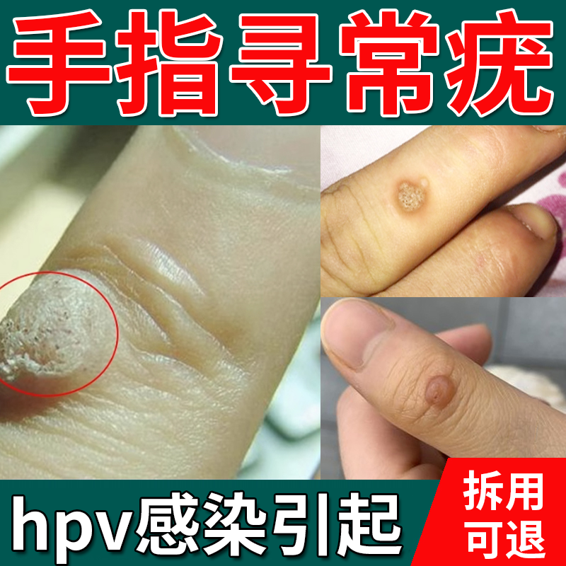 寻常疣专用膏去祛除神器根疣瘊肉粒一抹无忧猴子疙瘩肉刺疣瘊子HY