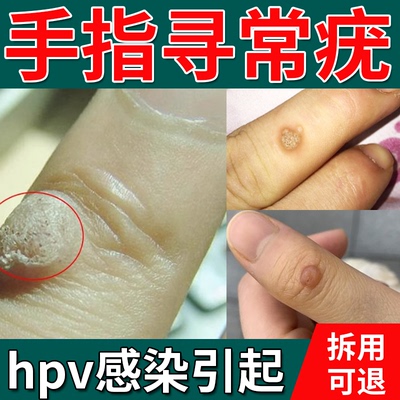手指寻常疣长小硬疙瘩