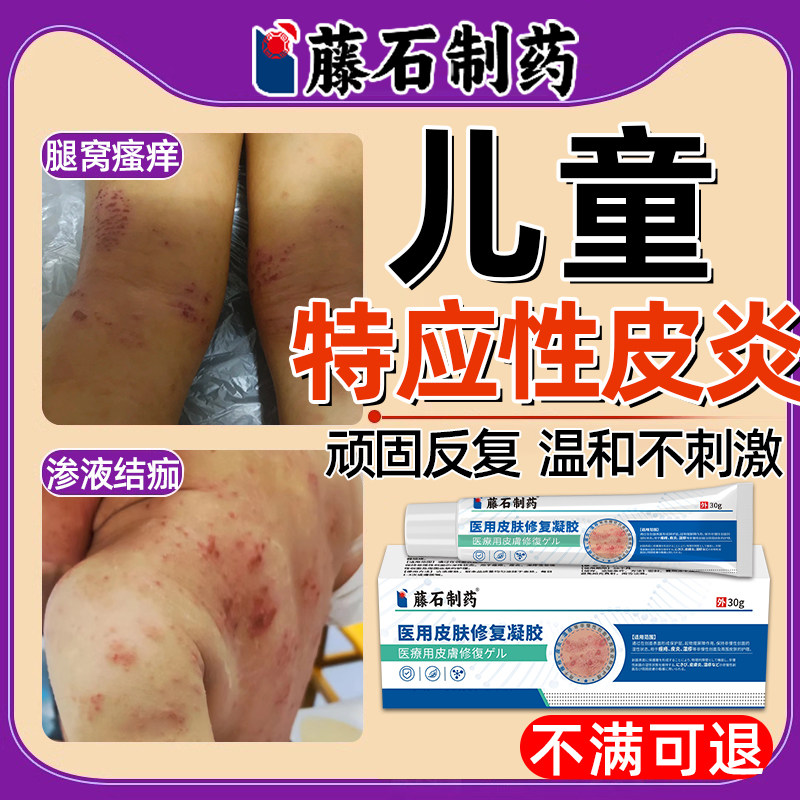 儿童特应性皮炎身体乳止皮肤痒瘙痒抑菌特异性宝宝湿疹软膏去SE