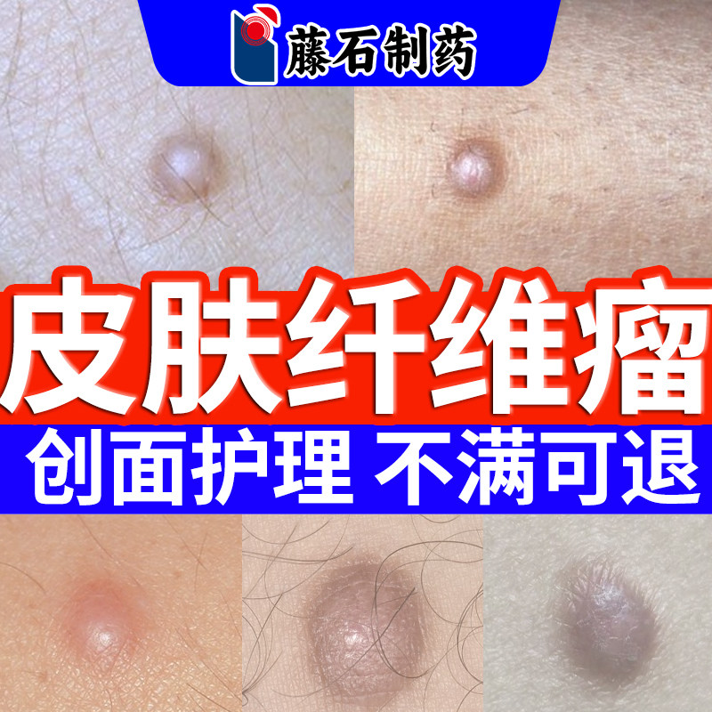 皮肤纤维瘤膏脂肪瘤膏肿硬块除可搭膏药贴皮下粉瘤疙瘩去SE