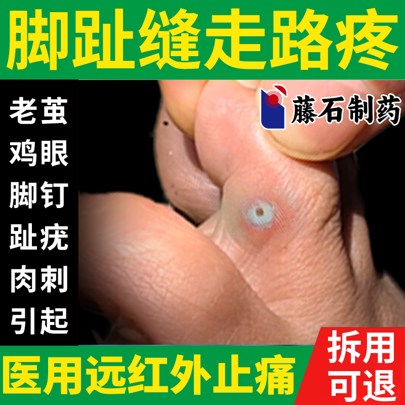 脚趾缝脚底鸡眼专用可搭膏药贴祛治老茧疗去足部脚上长跖疣疼痛HY