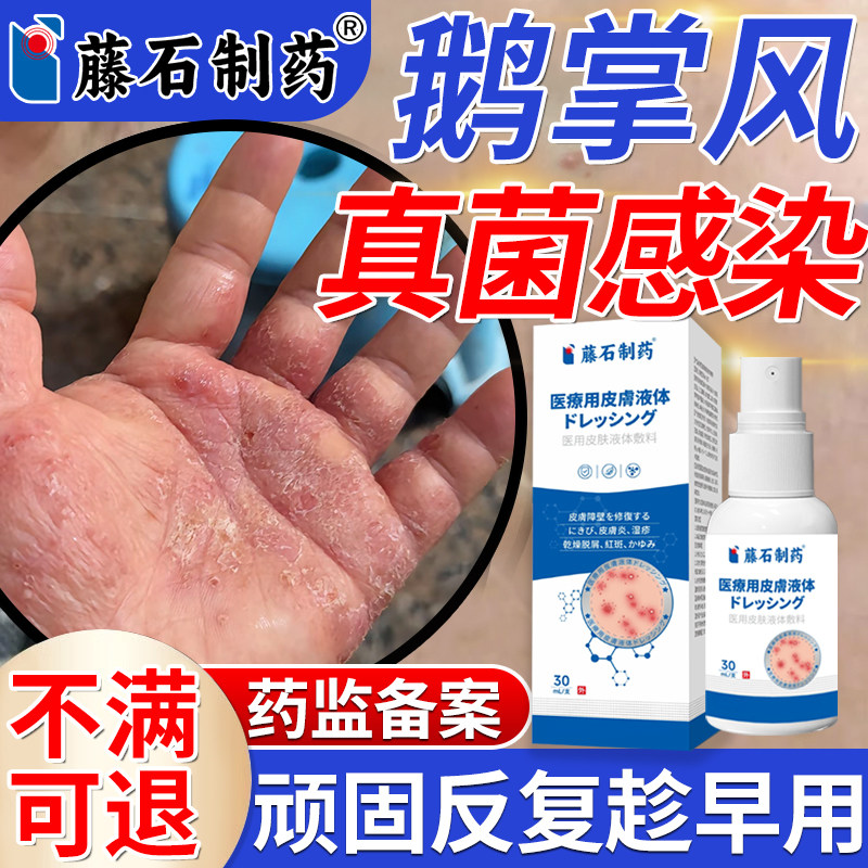 鹅掌风专用手癣搭膏药手掌脱皮干裂真菌感染角化型手部湿疹喷剂SE