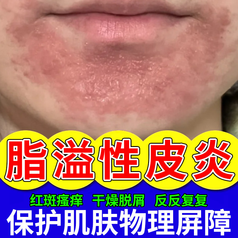脂溢性皮炎面部脸上嘴角下巴鼻翼护肤品面霜软膏脱皮干燥红痒起CS