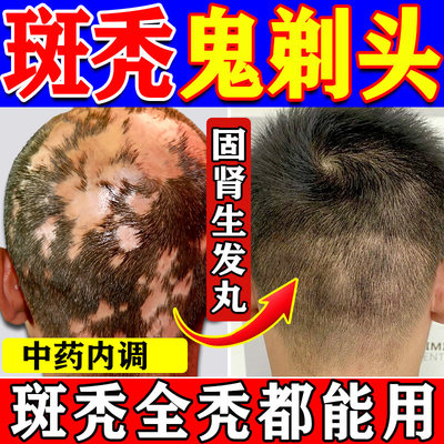 益气养血固肾生发丸胶囊治斑秃特鬼剃头效药特脱发脂溢性脱发专用