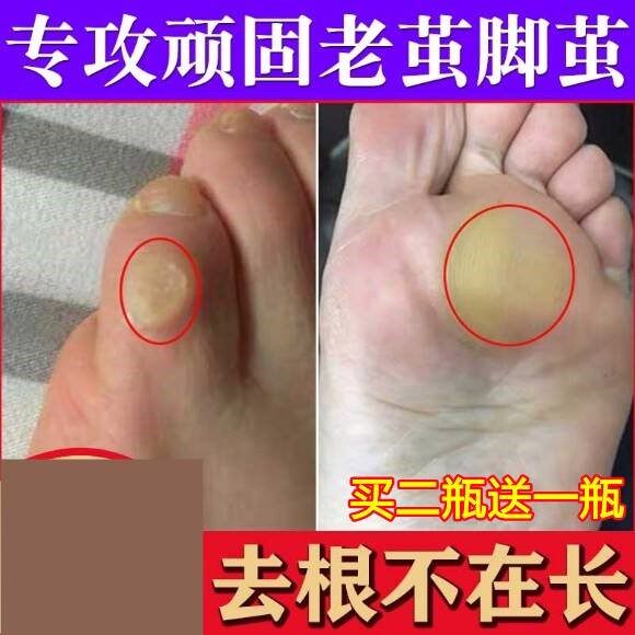 老茧去除手茧脚茧软化剂小脚趾胼胝膏治脚垫的药祛脚底硬死皮神器