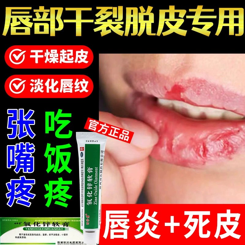 氧化锌软膏正品旗舰店唇炎专用药膏嘴唇干裂脱皮无激素成人儿童ZZ