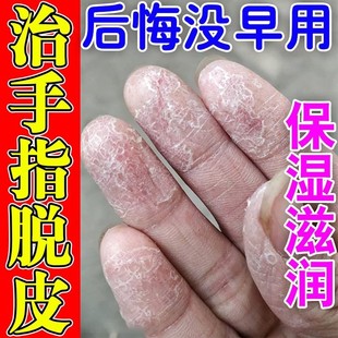 手脱皮严重脱皮专用季节性手指尖手心手掌手脚掉皮破皮褪皮爆皮痒
