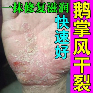 鹅掌风专用治干裂脱皮手藓膏真菌感染烂手鹅掌风克星硬皮裂口修复