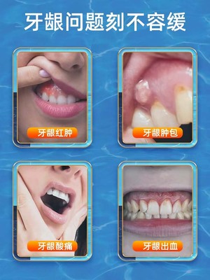 治牙龈根疗脓的包肿痛药上火消牙疼萎缩牙根暴露炎保护剂智齿的药