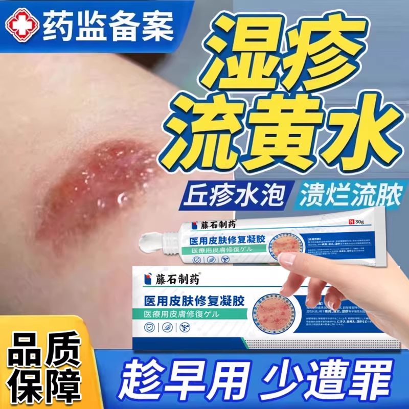 皮肤流黄水疮脓疱疮湿疹止瘙痒水泡渗液结痂去顽固皮炎根搭膏TU
