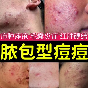 脓包型痤疮脸上起痘痘长痘痘脓包毛囊炎小疙瘩痤疮膜剂医用级XG