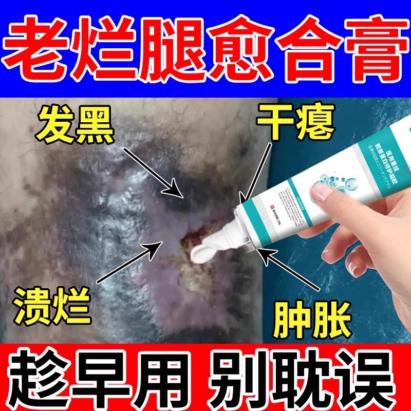 静脉曲张脉管炎老烂腿静脉炎冷敷凝胶专用可搭伤口愈合药房同款YZ - 实物图
