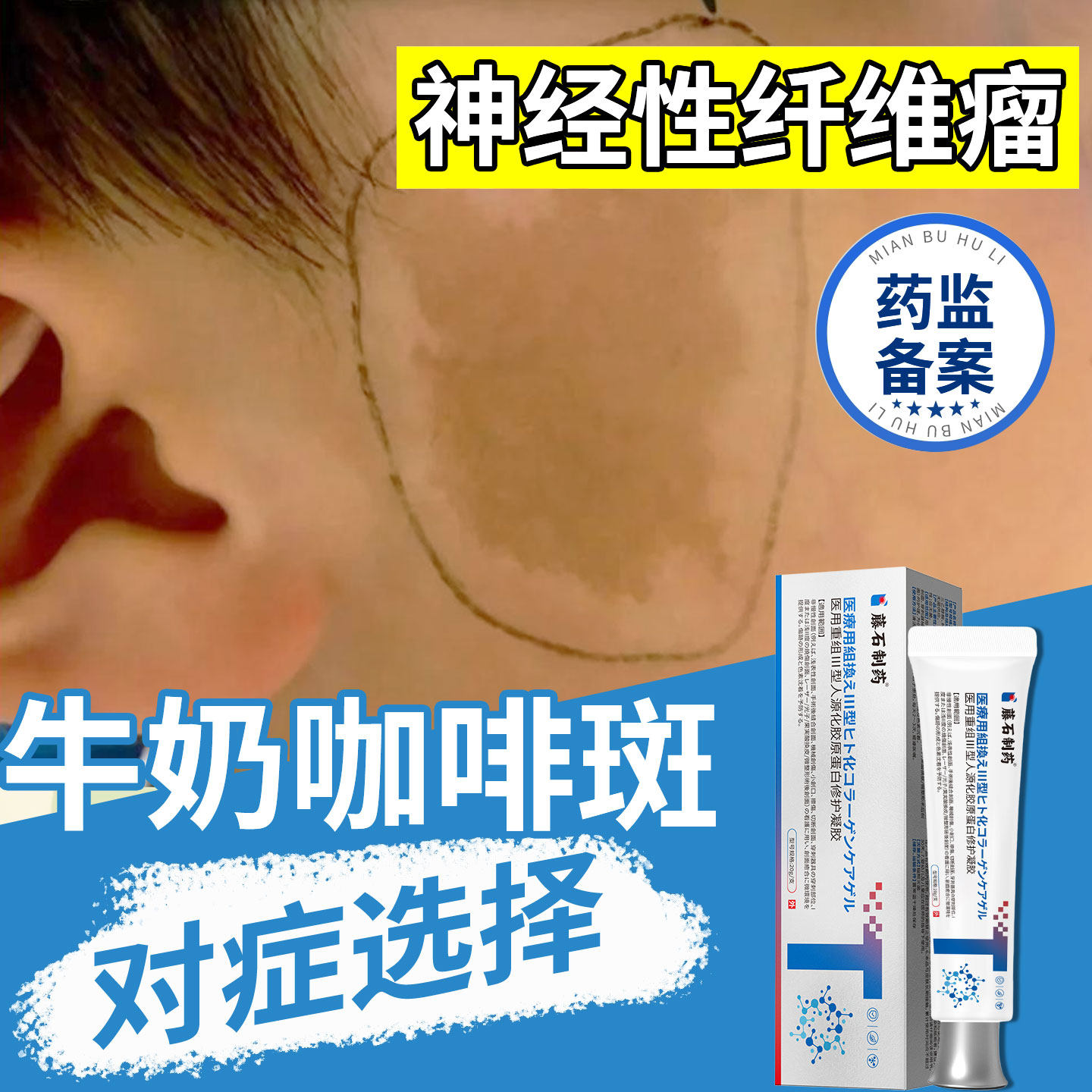 儿童神经性纤维瘤皮肤牛奶咖啡斑胎记去除神器防晒贴药房同款膏YZ