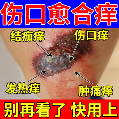 外伤愈合伤口痒专用喷剂医用瘙痒