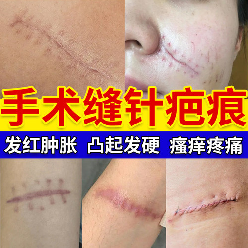 藤石制药手术后缝针疤痕平去疤膏