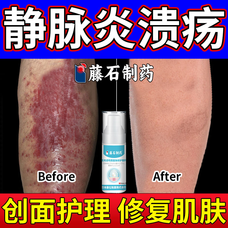 藤石透明质酸钠敷料静脉炎溃疡