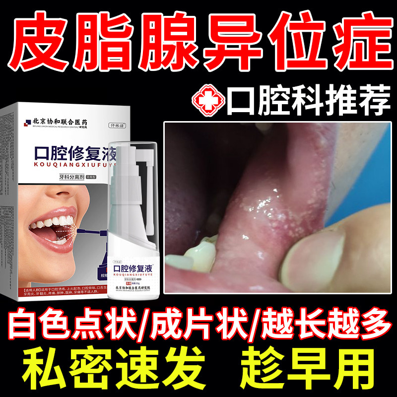 口腔皮脂腺异位症小白疙瘩脂肪小颗粒上颚嘴里面嘴唇增生喷剂yz