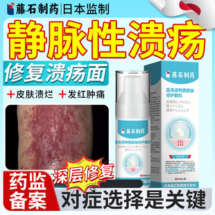 静脉炎溃疡专用静脉曲张脉管炎老烂腿敷贴淤积性皮炎药房同款膏YZ