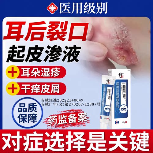 耳朵后面裂口起皮痒湿疹