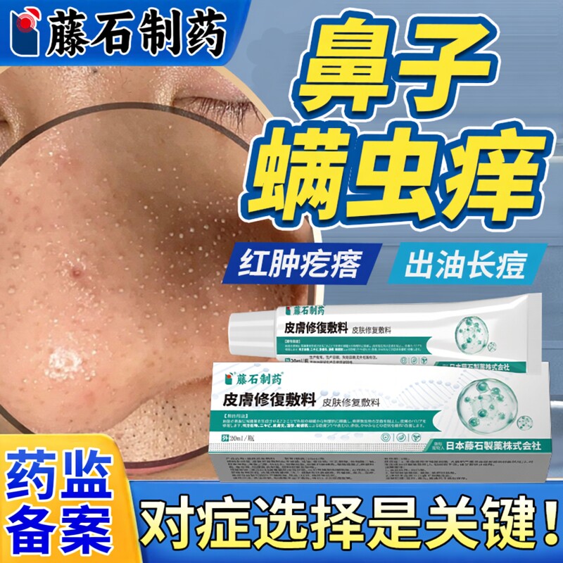 鼻子螨虫外面痒鼻头面部去除毛囊炎长红痘脱皮酒糟鼻玫瑰痤疮膏VQ