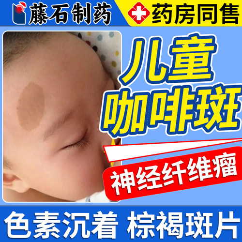 藤石制药儿童咖啡斑胎记