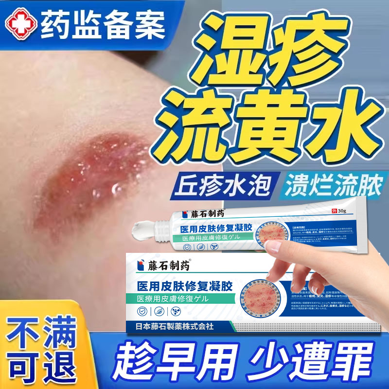 湿疹流黄水、黄水疮