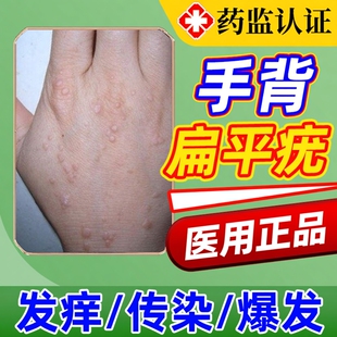 去手背上扁平疣专用去除膏一抹灵hpv病毒干扰素b2凝胶药房同款YZ