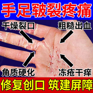 手裂开口子专用修复胶布带治干燥粗糙爆干皮愈合膏贴的药房同款YZ